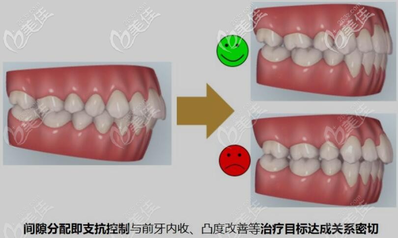 美國隱適美隱形牙套做拔牙矯正效果好嗎tc2內收前牙轉矩很重要