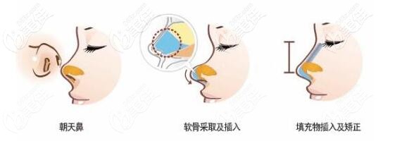 挛缩鼻修复方法