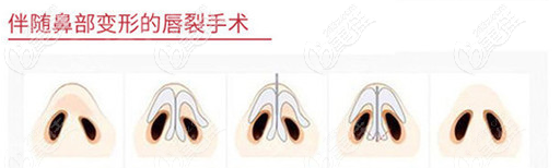 兔唇鼻子塌修复手术过程