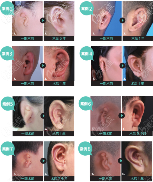 小耳畸形耳再造手术的效果好坏与残耳的多少和皮肤的回缩性有关