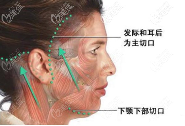 面部大拉皮手术切口位置示意图