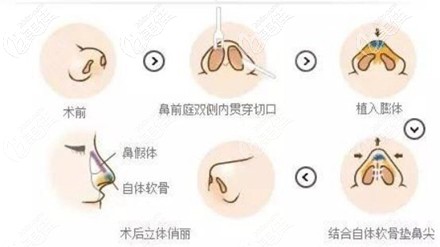 雅美整形的隆鼻手术主要由院内的吴谦医生亲自操作,他本人是雅美整形