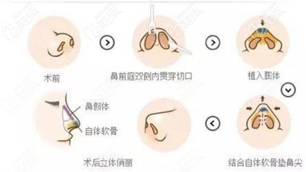 鼻综合手术过程