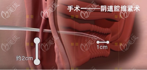 生物束带私密紧缩术之阴道腔紧缩术步骤一