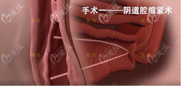 生物束带私密紧缩术之阴道腔紧缩术步骤二