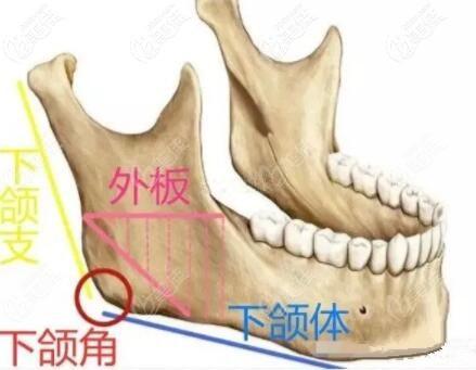 看下图,外板是下颌骨的组成部分,它是决定下颌角厚度的,一般外板厚的