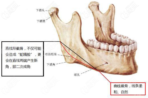 akin截骨示意图图片