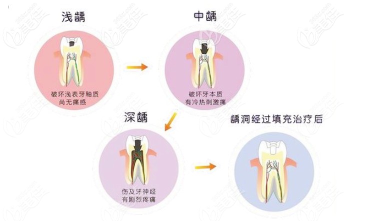 蛀牙程度的几个阶段