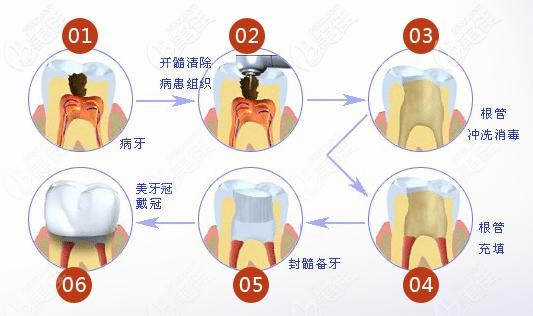 补牙流程图图片