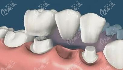 不要再傻傻問種植牙和搭橋牙哪個好了內行人都知道固定烤瓷橋不便宜還