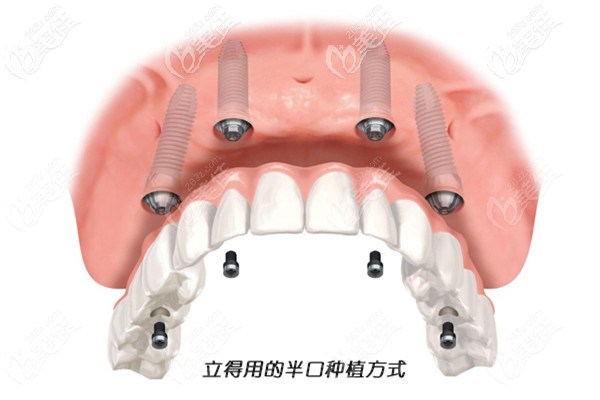 立得用种植牙的原理