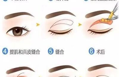 【全切双眼皮】韩式全切双眼皮，让你拥有完美电眼活动海报五