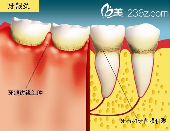 牙齦炎圖片是怎樣的孕婦患牙齦炎要怎麼處理